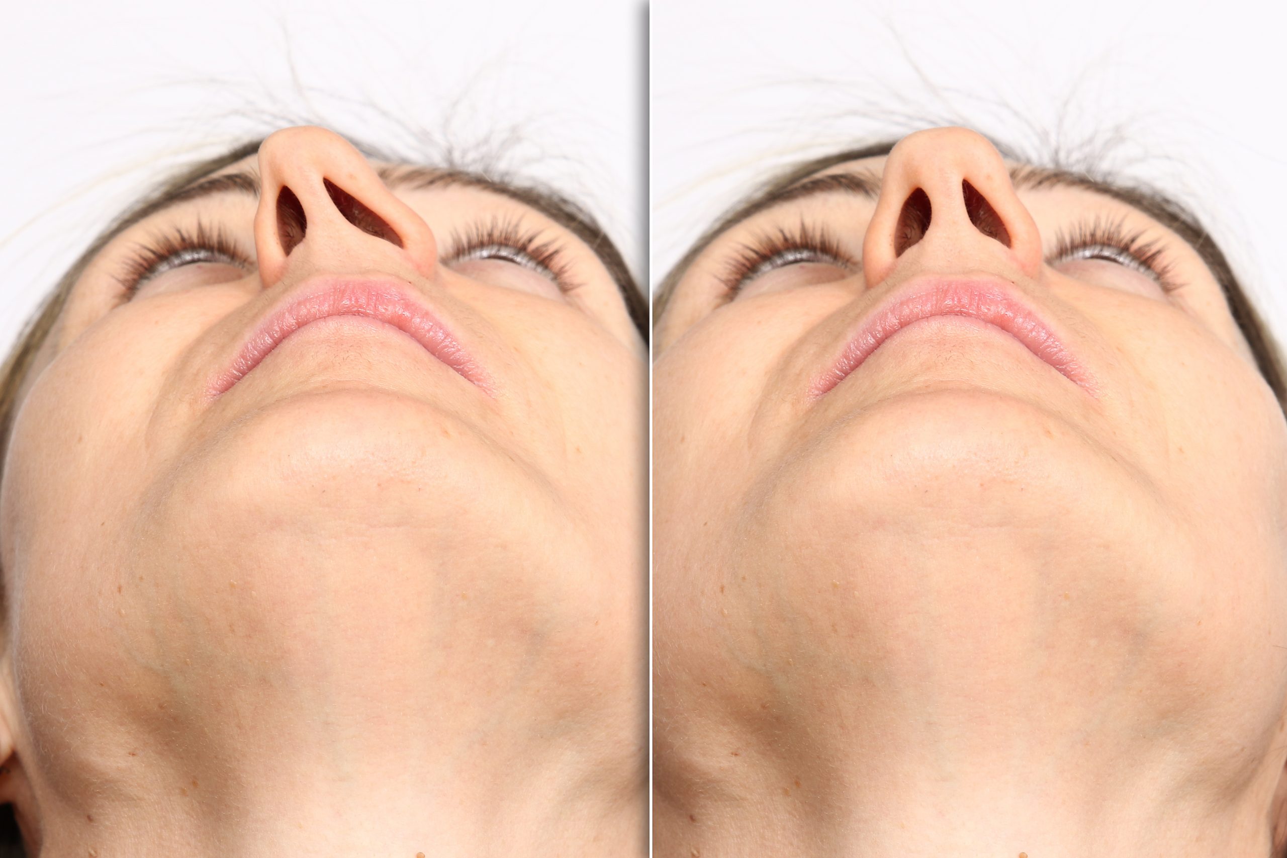 deviated septum, woman with deviated septum and corrected septum
