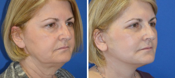woman before and after neck lift
