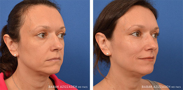 facial-fillers-before-and-after mid age woman before and after liquid facelift procedure