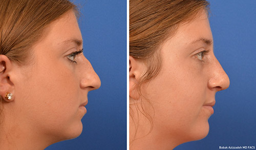 Revision Rhinoplasty Before & After