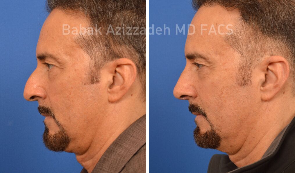 Rhinoplasty Austin