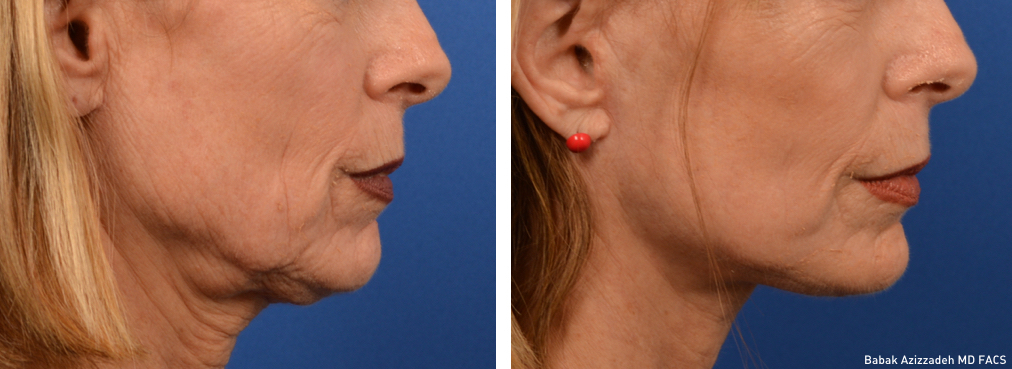 Look Younger With Laser Skin Resurfacing Center