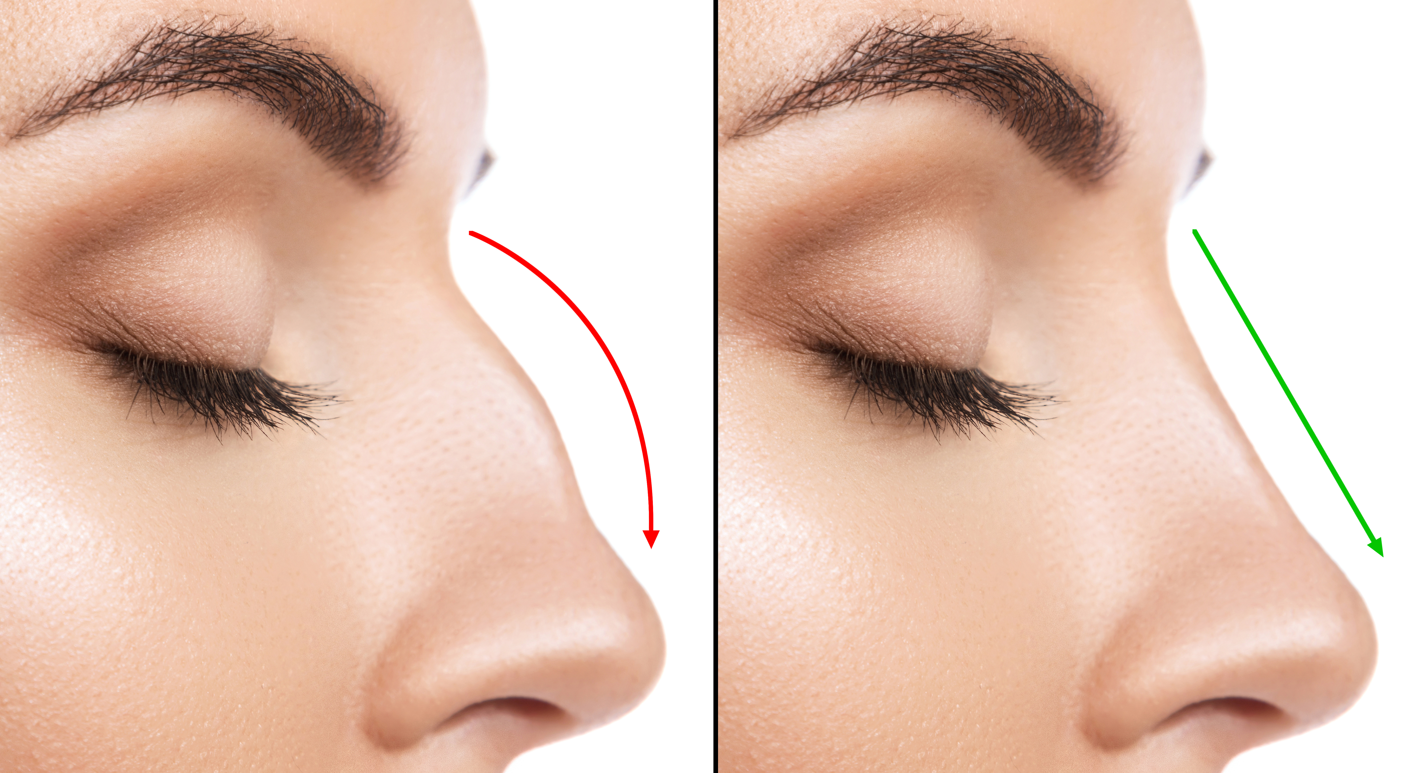 The Advances of Nasal Reconstruction Surgery