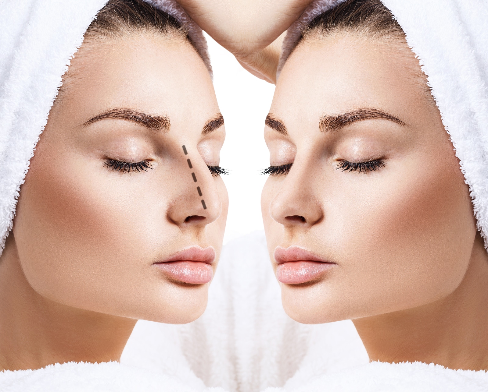 The Difference Between Open and Closed Rhinoplasty | CENTER