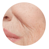 Loss of Skin Firmness