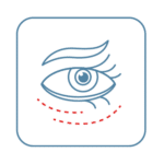 A drawing of an eye with redlines below showing where the bags can be removed