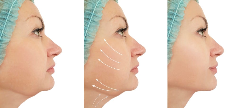 What to Expect After Chin Liposuction | CENTER