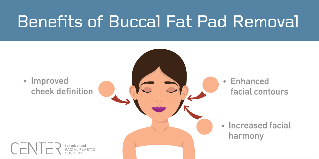 Benefits of Buccal Fat Pad Removal
