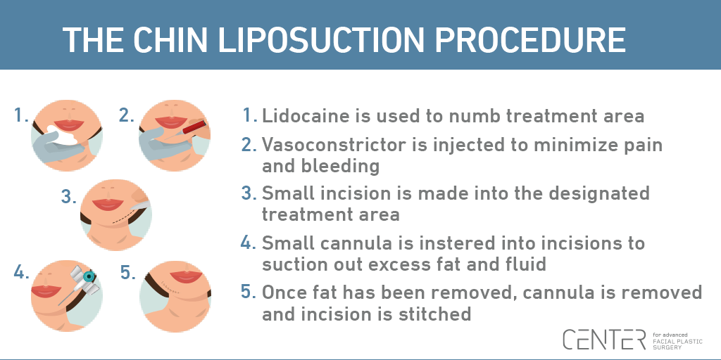 The Chin Liposuction Procedure