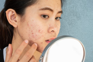 Facial Plastic Surgery Candidate with Acne