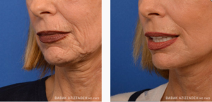 woman before and after laser skin resurfacing