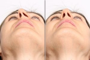 Woman with deviated septum and corrected septum