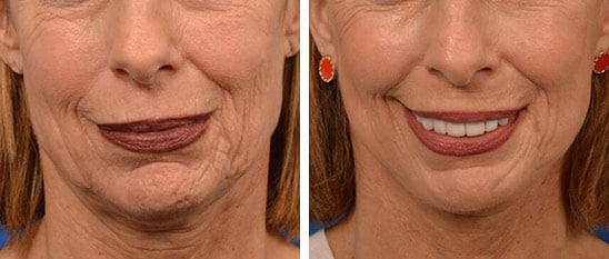 Facelift Before and After