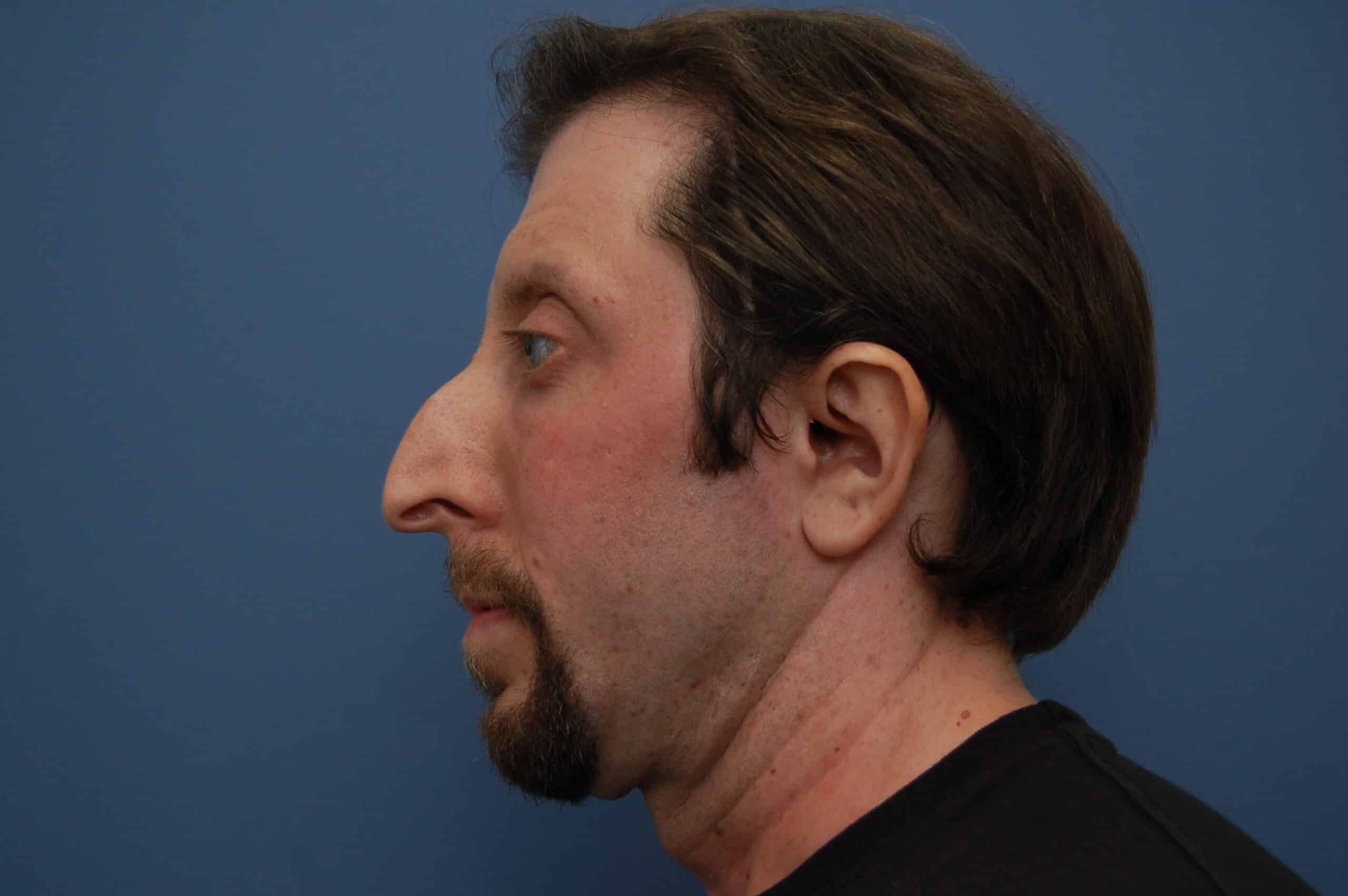 Successfully Nose Job Before and After