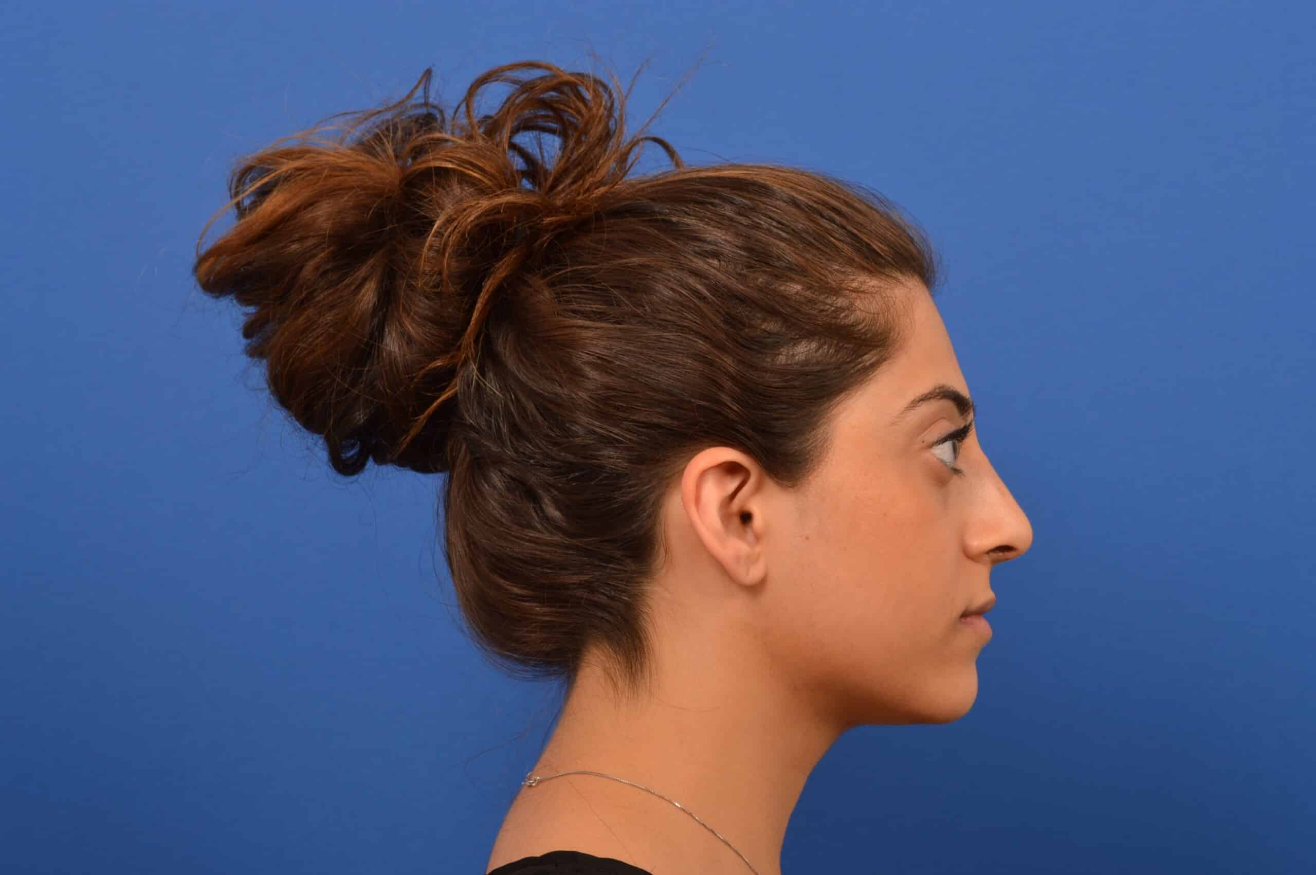 Rhinoplasty Outcome Before and After