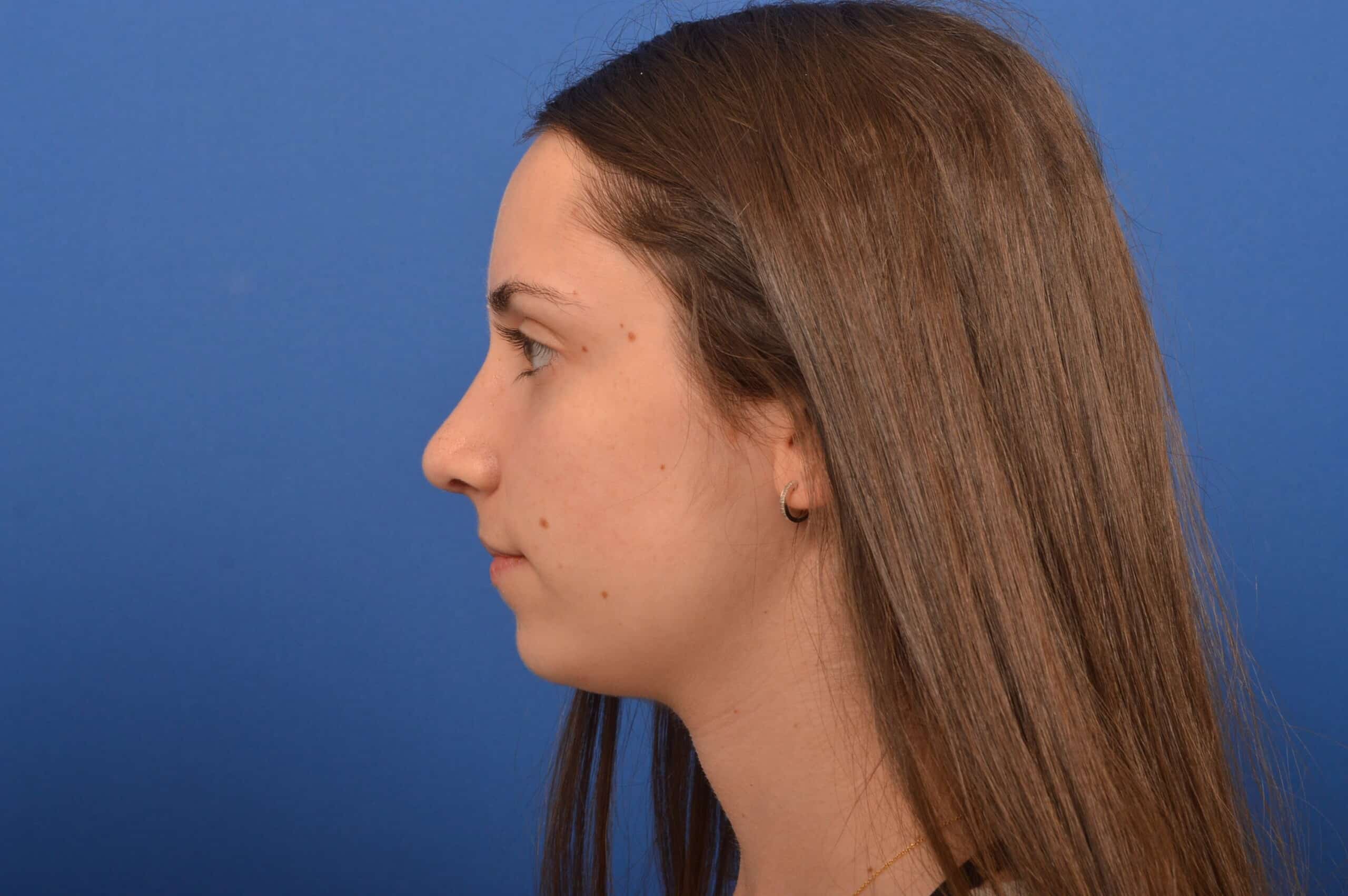 Nose Job Results Before and After