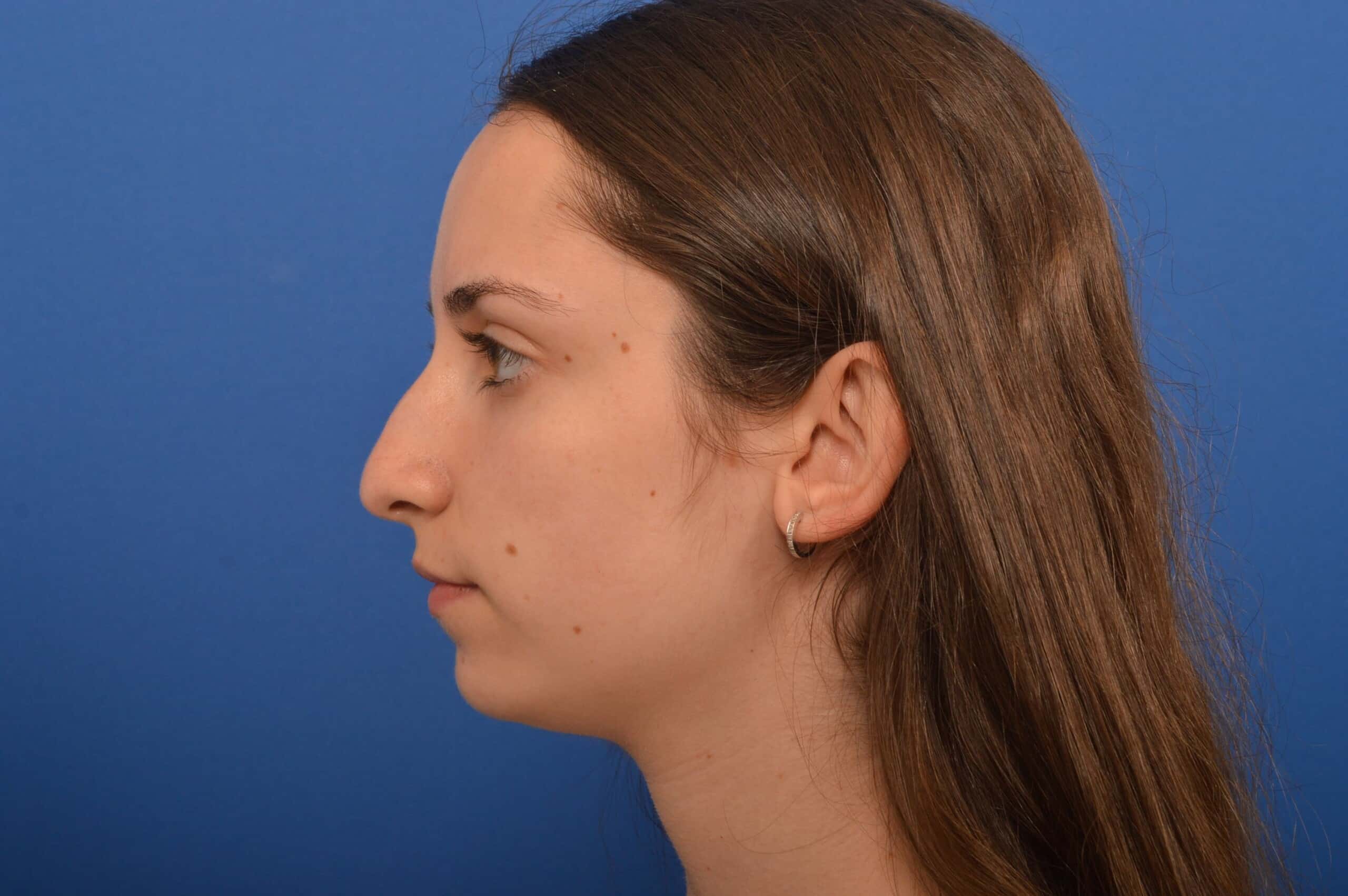 Nose Job Results Before and After