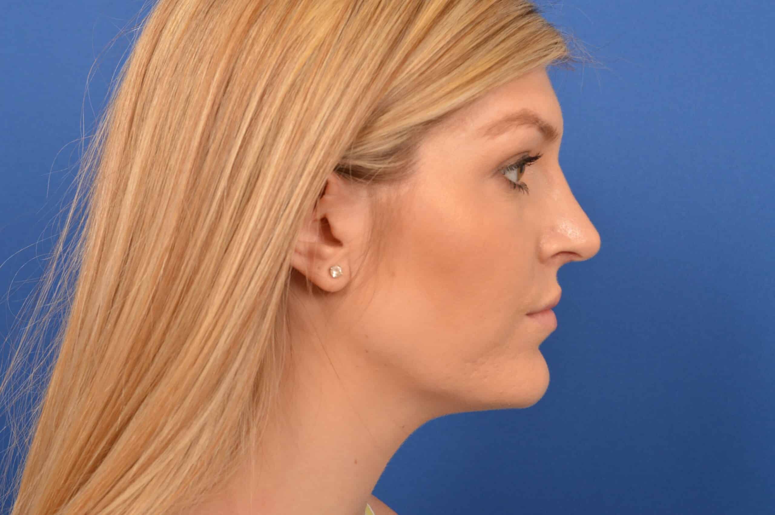 Nose Job Evolution Before and After
