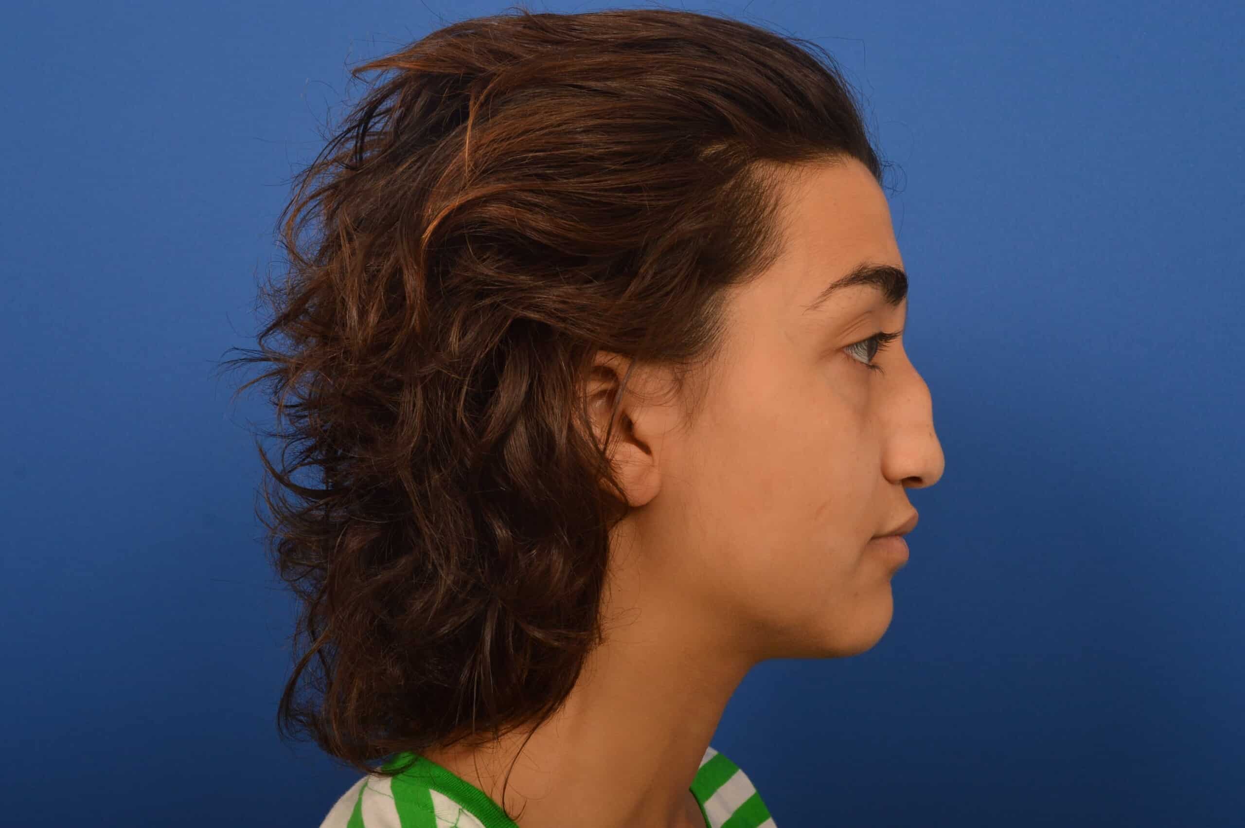 Rhinoplasty Results Before and After