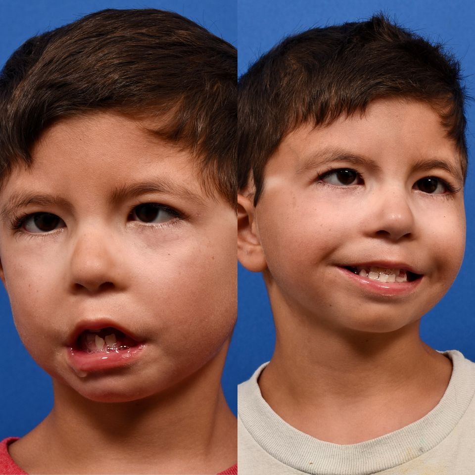 A young boy after facial paralysis surgery before and after pictures. Smile reanimation transformation pictures.
