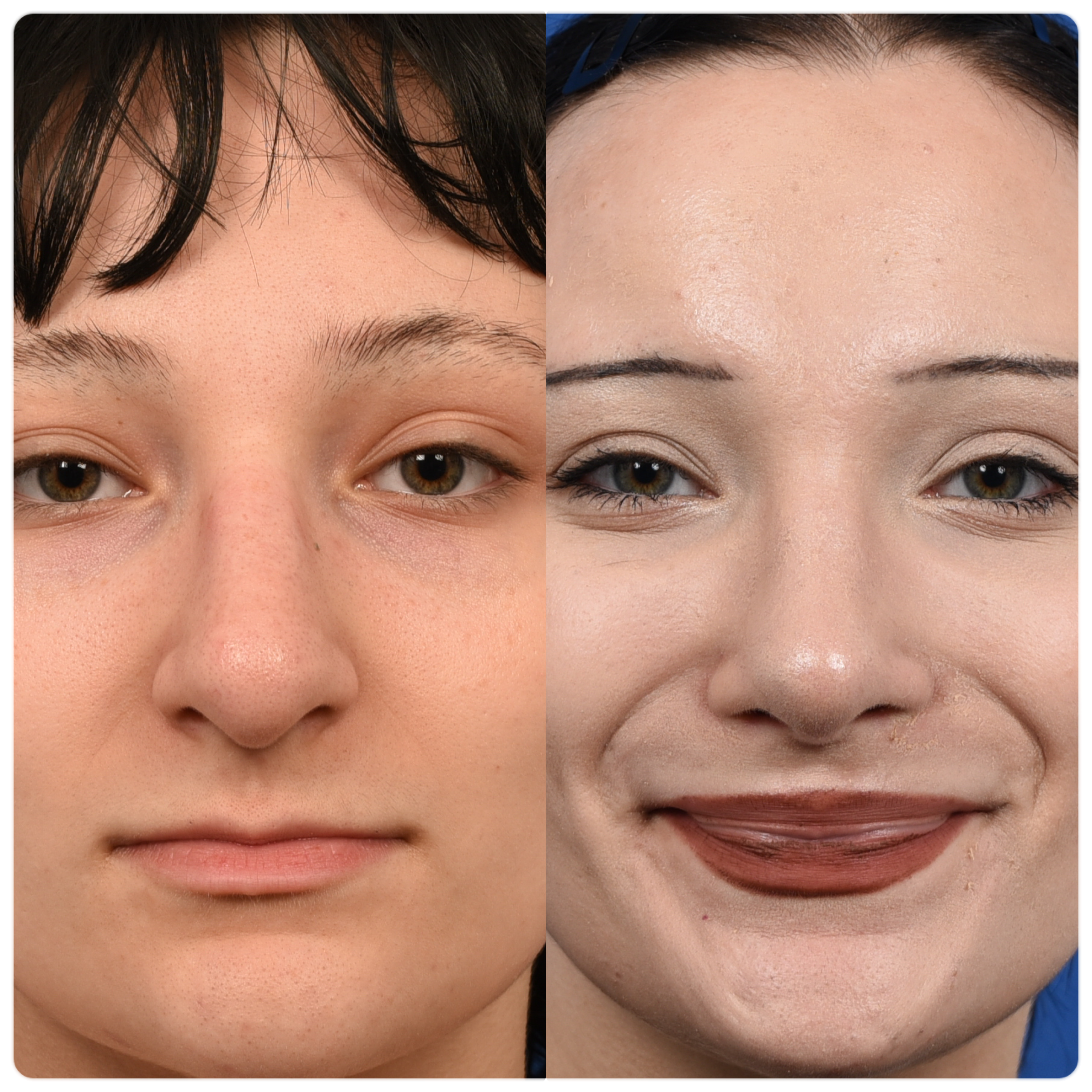 A woman with a rhinoplasty before and after pictures. Nose job transformation photos.