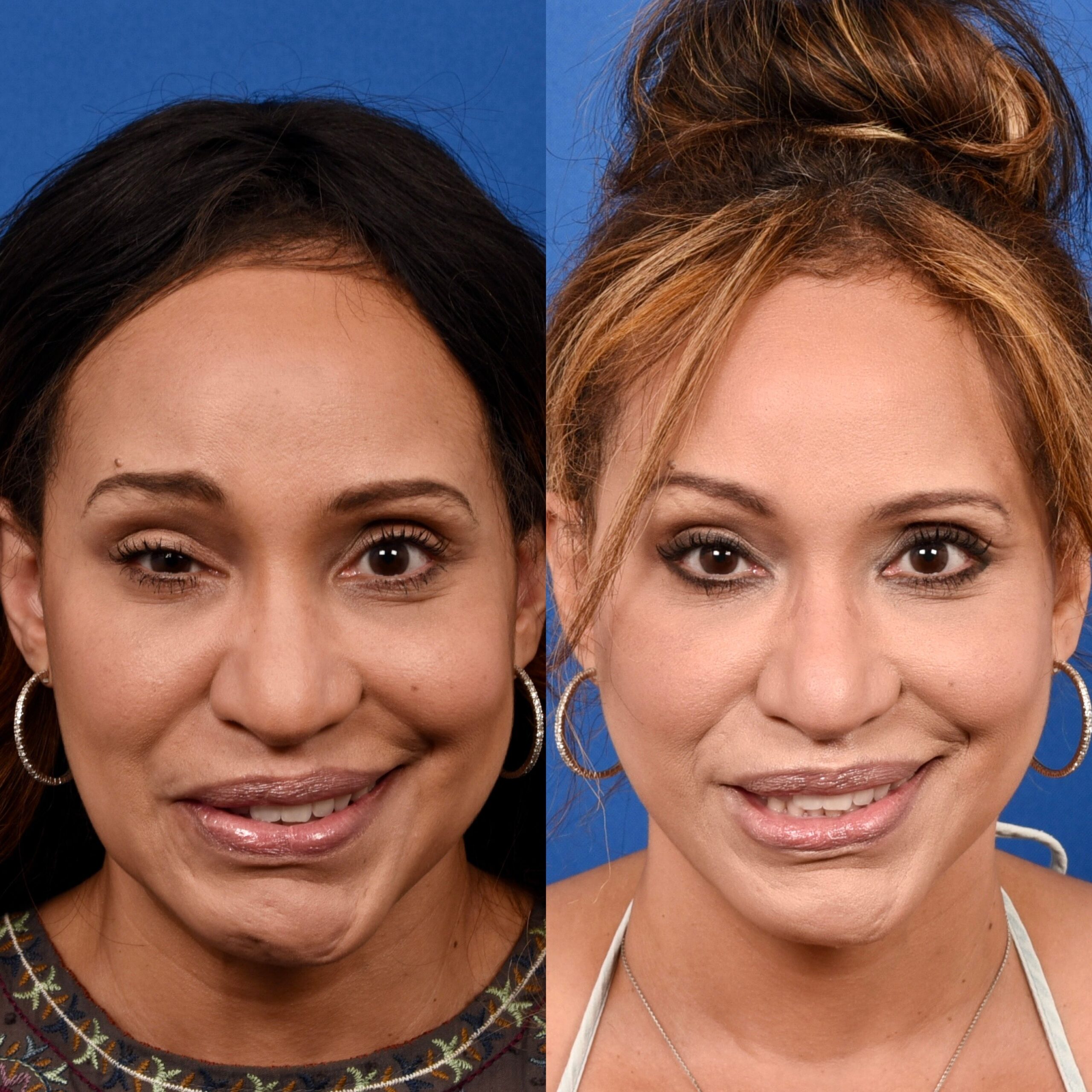 A woman after facial paralysis surgery before and after pictures. Smile reanimation transformation pictures.