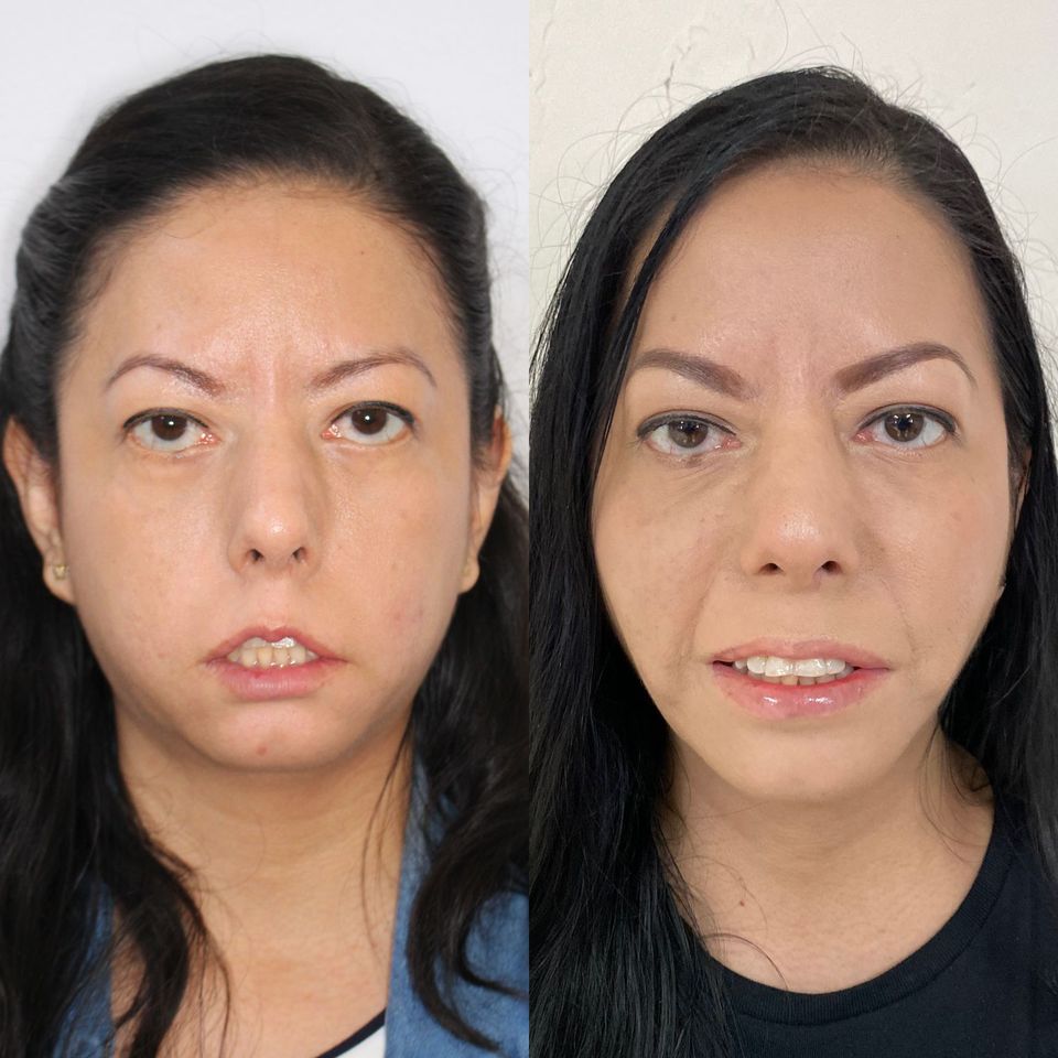 A woman with facial paralysis surgery before and after pictures. Moebius syndrome transformation photos.