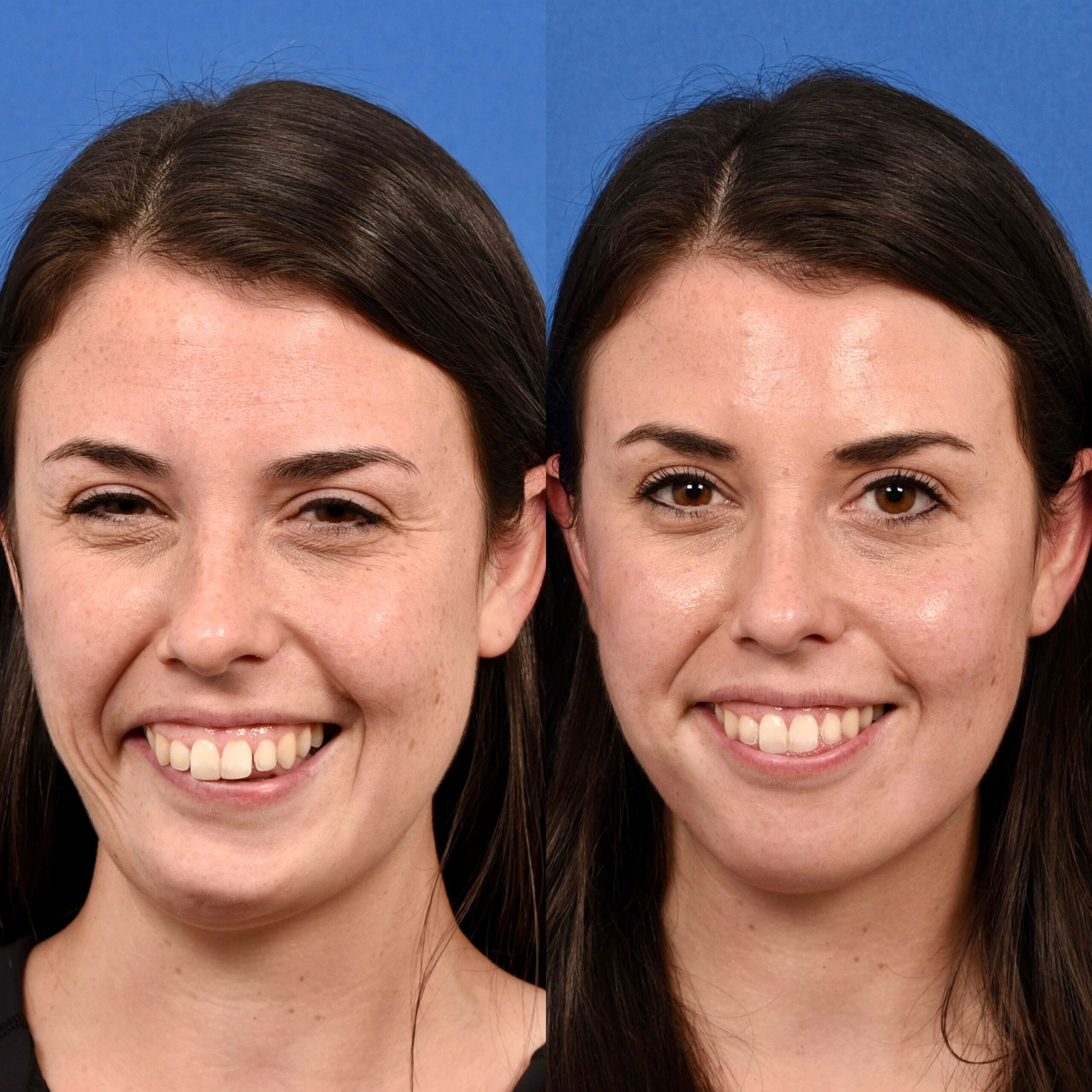A woman after facial paralysis surgery before and after pictures. Smile reanimation transformation pictures.