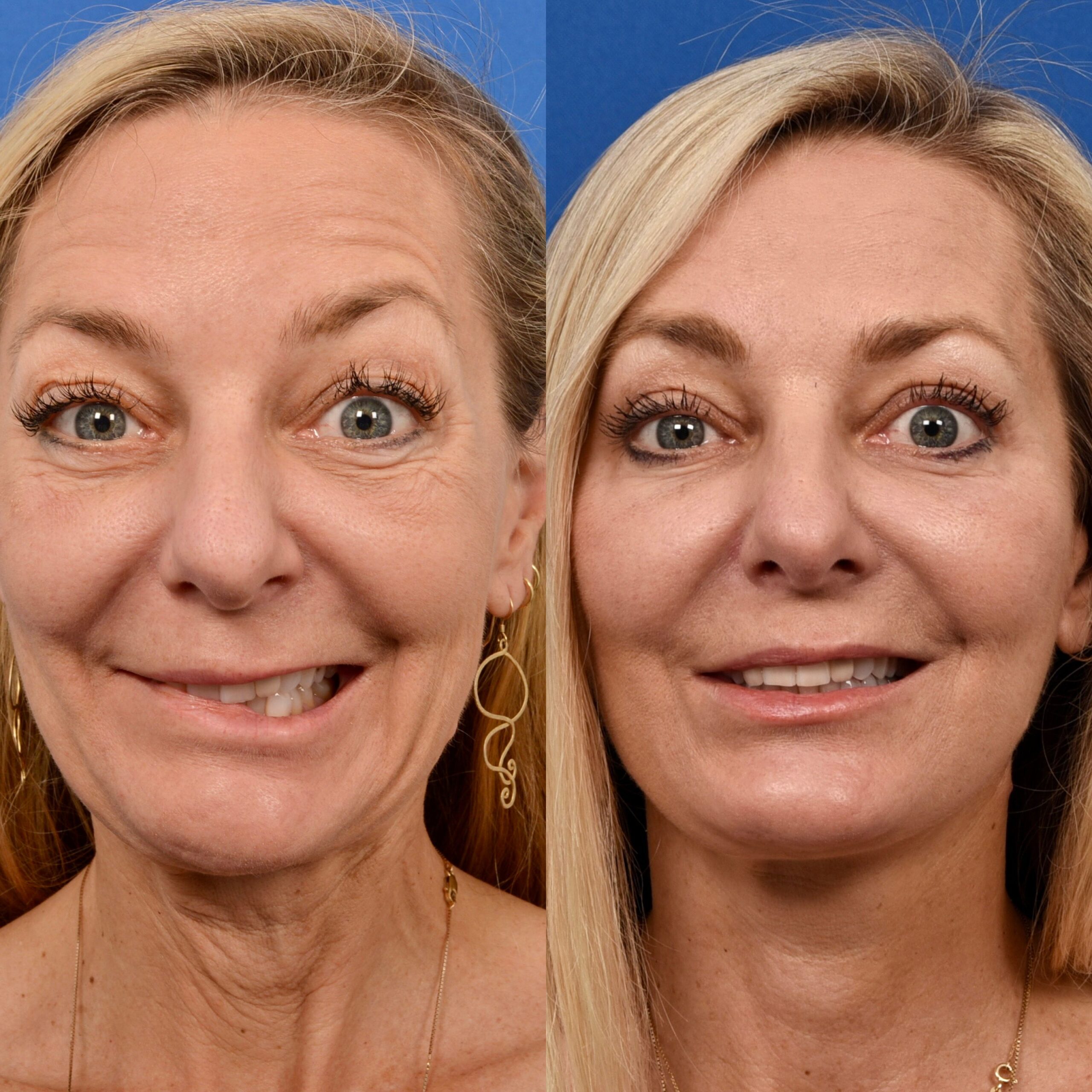 A woman with facial paralysis surgery before and after. Smile reanimation transformation pictures.
